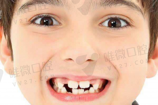 虫牙和龋齿怎么区别（蛀牙是牙齿有虫吗）注意事项！(图1)